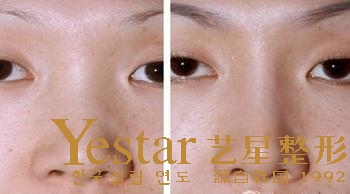 假体隆鼻使鼻子越高越好吗