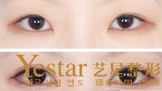 武汉开眼角手术会对眼睛有伤害吗
