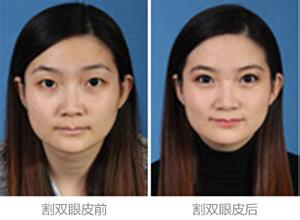 割双眼皮图片
