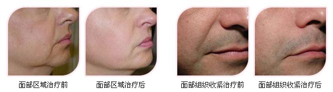 塑美极除皱图片