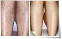 激光脱小腿毛