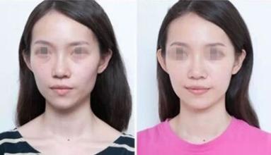 玻尿酸丰太阳穴