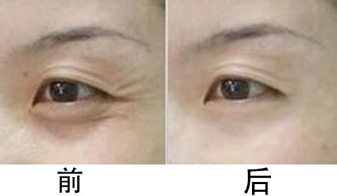 玻尿酸祛鱼尾纹