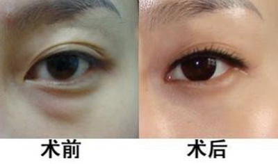 祛眼袋前需要了解的一些基本常识