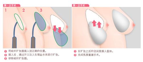 乳房再造过程