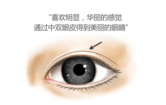 双眼皮