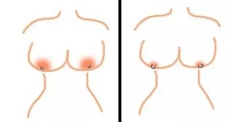 做乳晕缩小术会疼吗