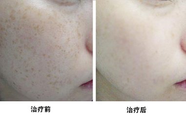 激光祛雀斑会损伤皮肤吗