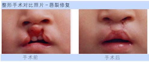 兔唇什么时候修复好呢