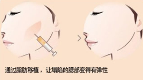 自体脂肪面部填充多久会恢复自然