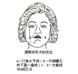 做酒窝成形过程是怎样的