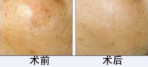 激光祛老年斑需要几次