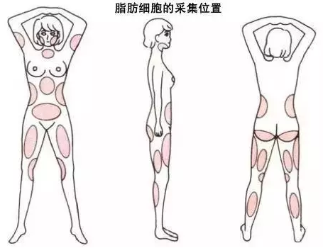 全身吸脂效果好吗