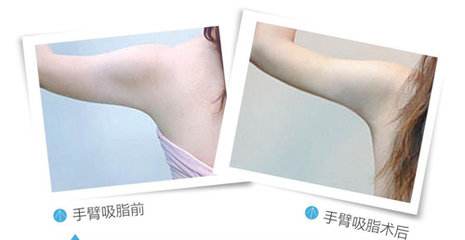 武汉手臂吸脂怎么样