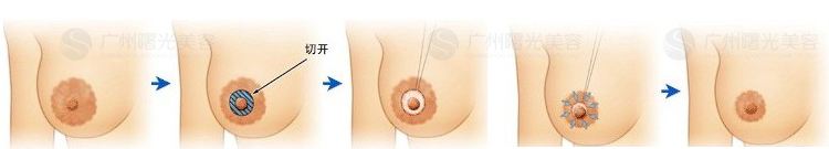 乳晕缩小术具体手术过程