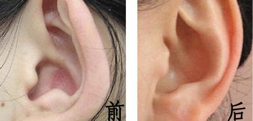 招风耳整形步骤有哪些