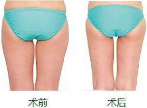 腿部吸脂
