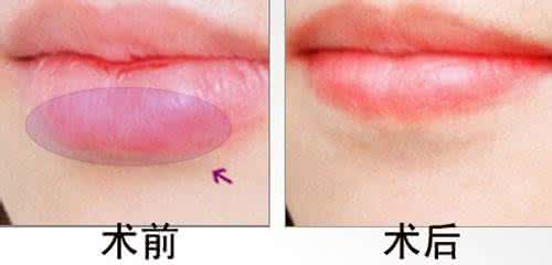 唇部整形