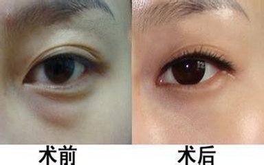 武汉激光去眼袋术后如何护理?