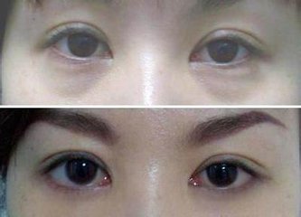 武汉激光祛眼袋有什么优势?