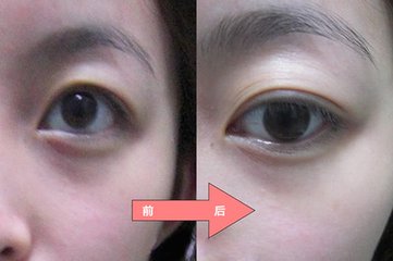 武汉除黑眼圈的价格是多少?