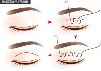 武汉埋线双眼皮适应症有哪些?