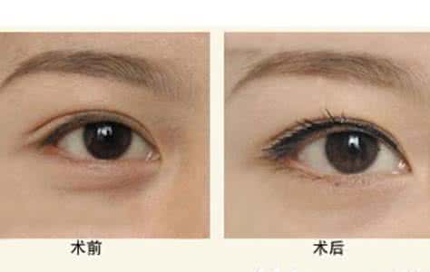 武汉做完超声波去眼袋后应该注意些什么?
