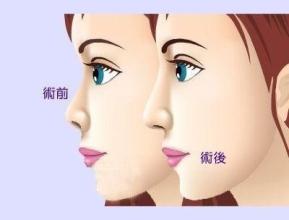 武汉自体脂肪隆鼻比较可靠的医院?