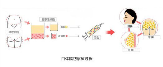 武汉自体脂肪隆鼻比较可靠的医院?