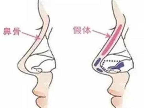 武汉假体隆鼻后应该怎样护理?