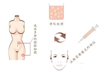 武汉自体脂肪隆鼻的效果怎么样?