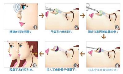 武汉膨体隆鼻的效果怎么样?