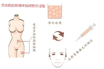 武汉自体脂肪丰太阳穴的价格是多少?