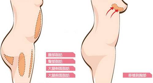 武汉自体脂肪丰胸有什么优势