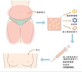 武汉自体脂肪丰胸术哪里做好?