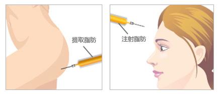 武汉自体脂肪丰额头疼吗?