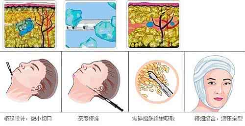 武汉面部吸脂多长时间可以恢复?