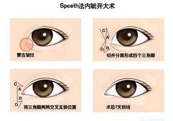 武汉做开眼角手术有风险吗?