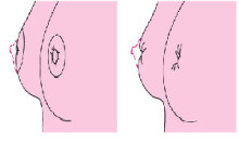 武汉做乳头内陷矫正手术吗?