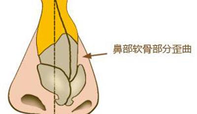 武汉歪鼻子是哪些因素照成的