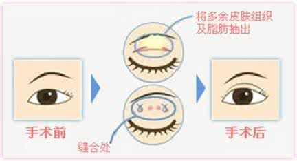 武汉双眼皮的效果维持多久?