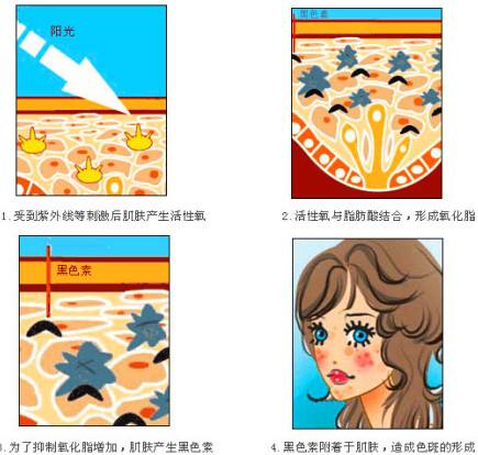 雀斑是怎么产生的?