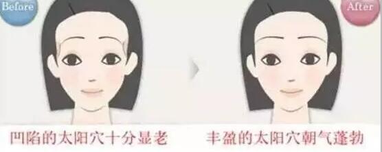武汉丰太阳穴手术有哪些方法