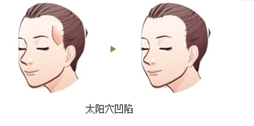 武汉脂肪丰太阳穴后需要多久恢复
