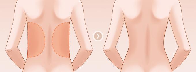 武汉腰腹吸脂影响内分泌吗