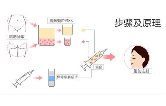 武汉自体脂肪有什么作用