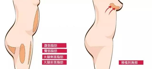 武汉自体脂肪丰胸效果好吗