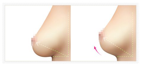 武汉乳房下垂矫正效果怎么样