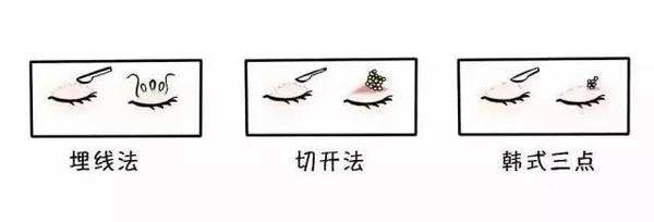武汉做双眼皮选择价格还是技术