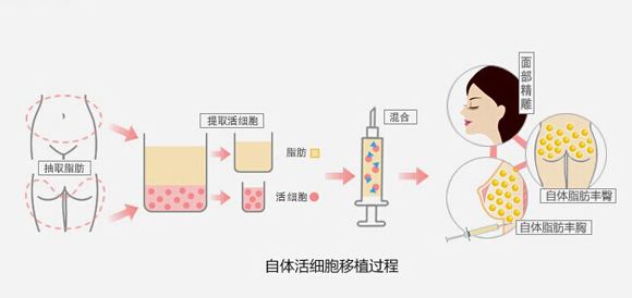 武汉能用他人脂肪做填充吗